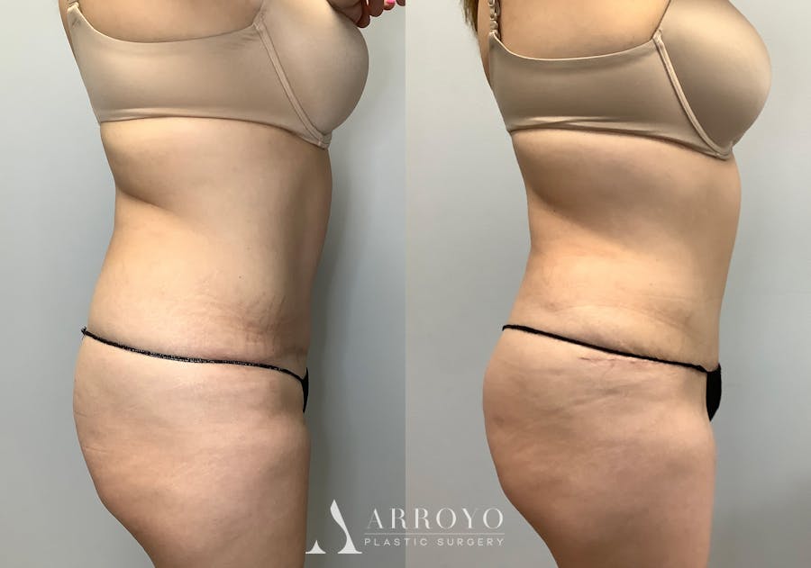 Tummy Tuck Before & After Gallery - Patient 141595133 - Image 3