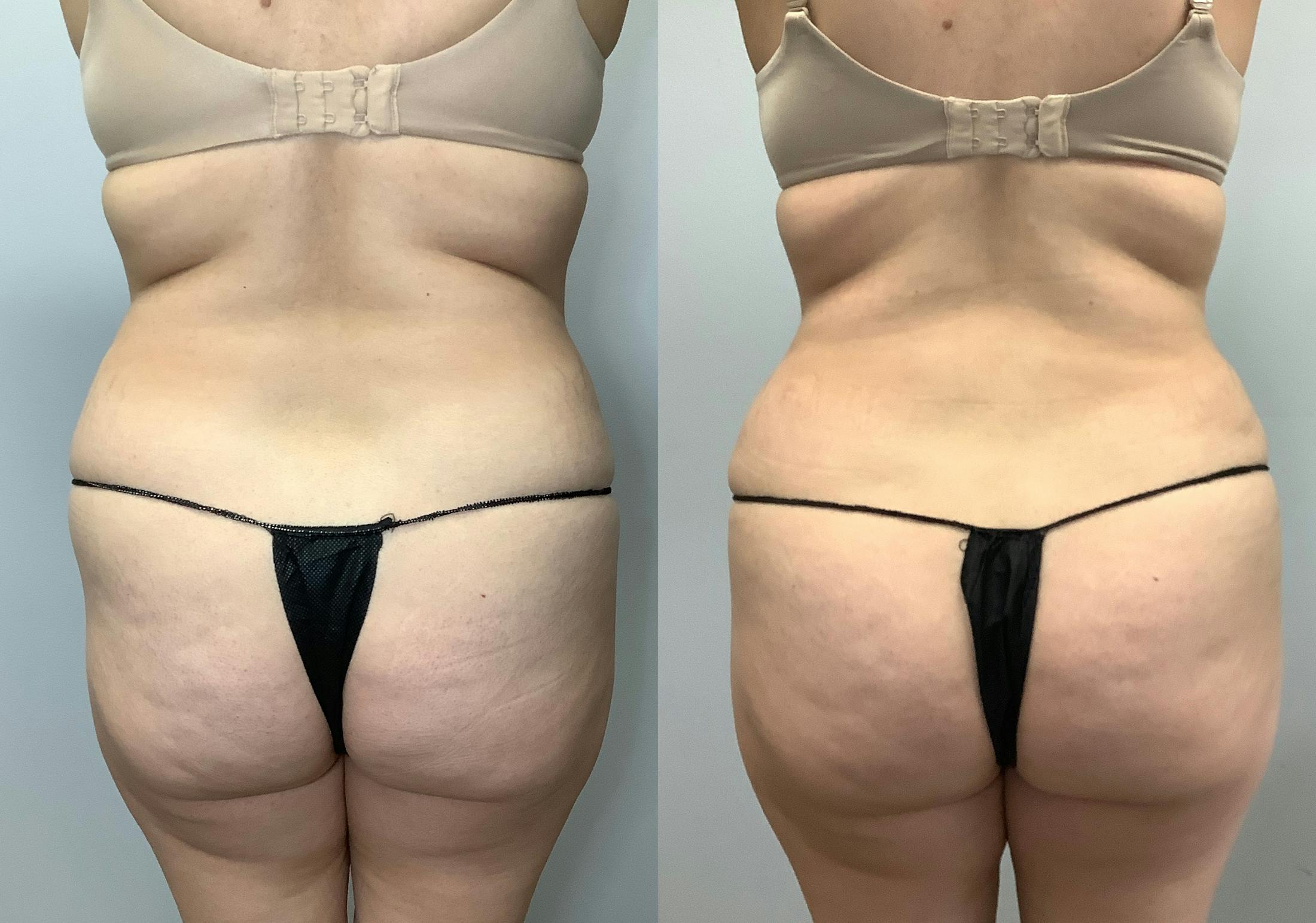 Liposuction Before & After Gallery - Patient 141595132 - Image 4
