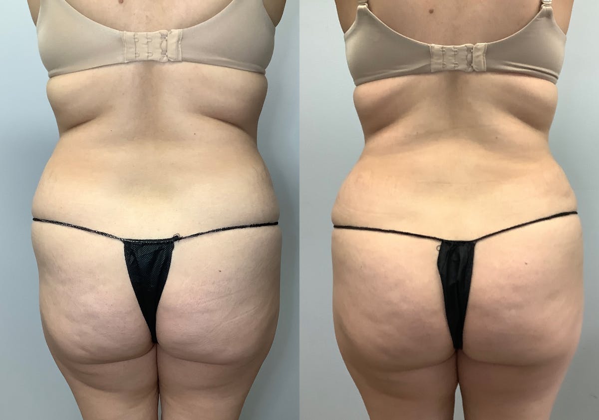 Liposuction Before & After Gallery - Patient 141595132 - Image 4