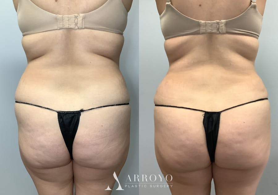 Tummy Tuck Before & After Gallery - Patient 141595133 - Image 4