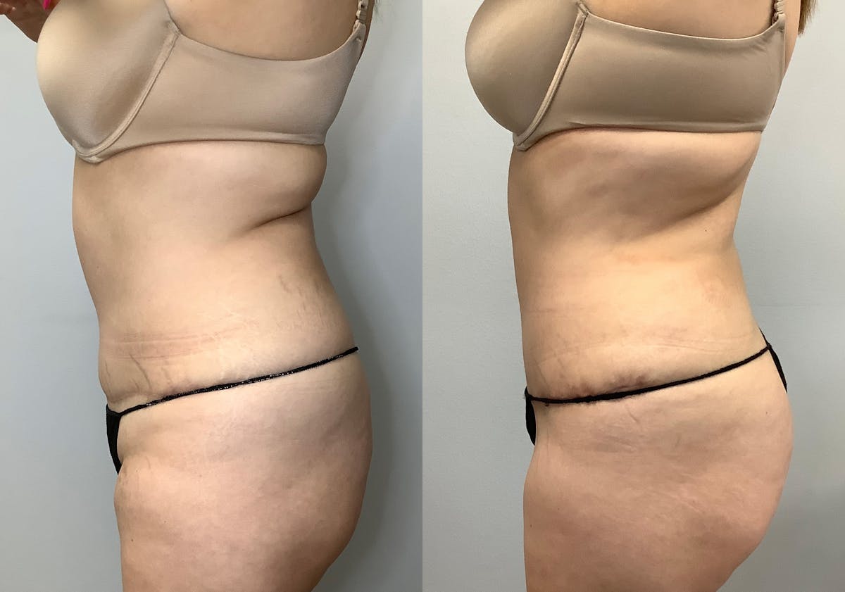 Liposuction Before & After Gallery - Patient 141595132 - Image 5