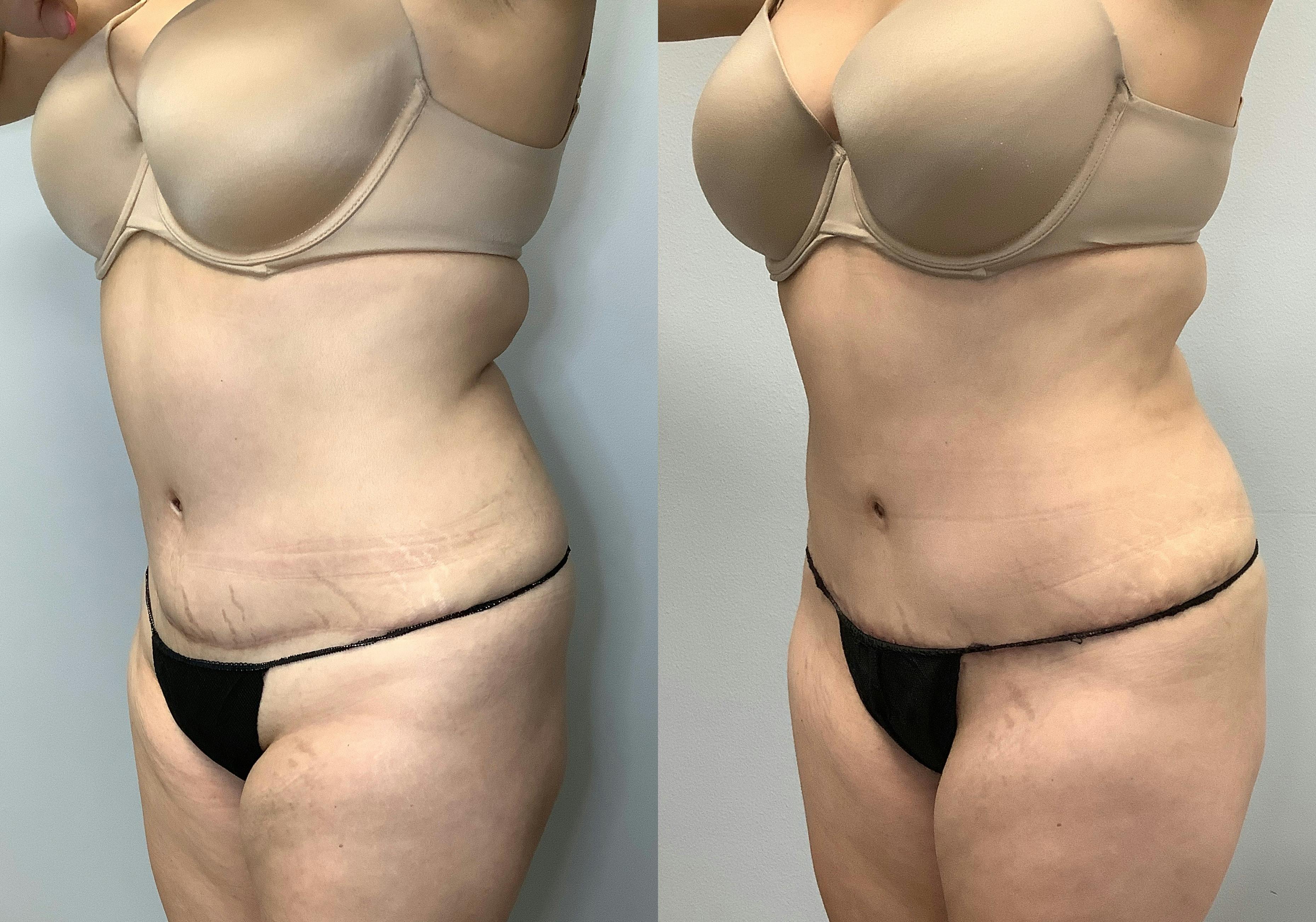 before and after of a Houston tummy tuck patient - 04