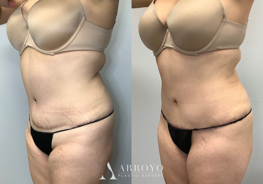 Tummy Tuck Before & After Gallery - Patient 141595133 - Image 6