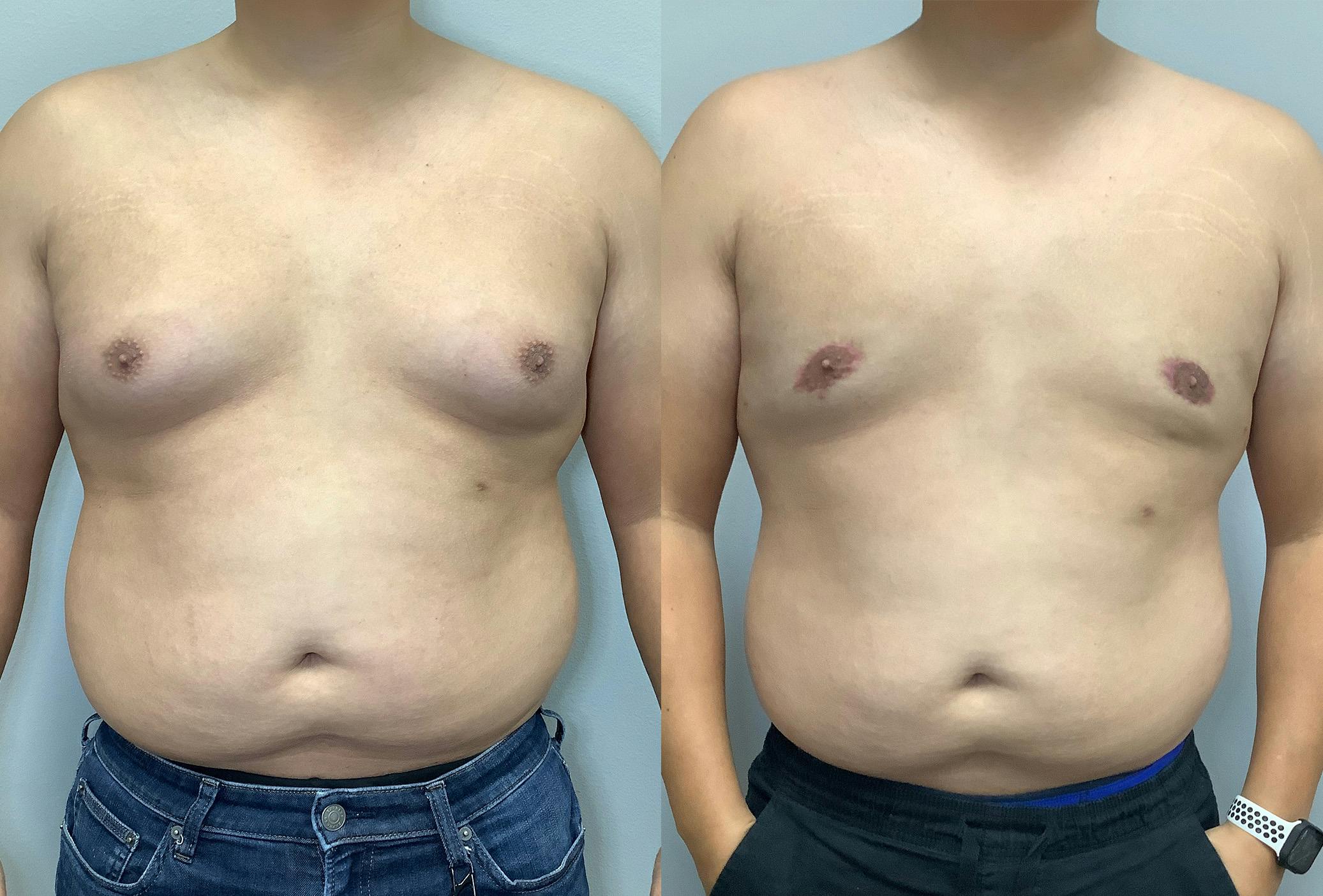 Before and After Male Breast Reduction in Houston - 01