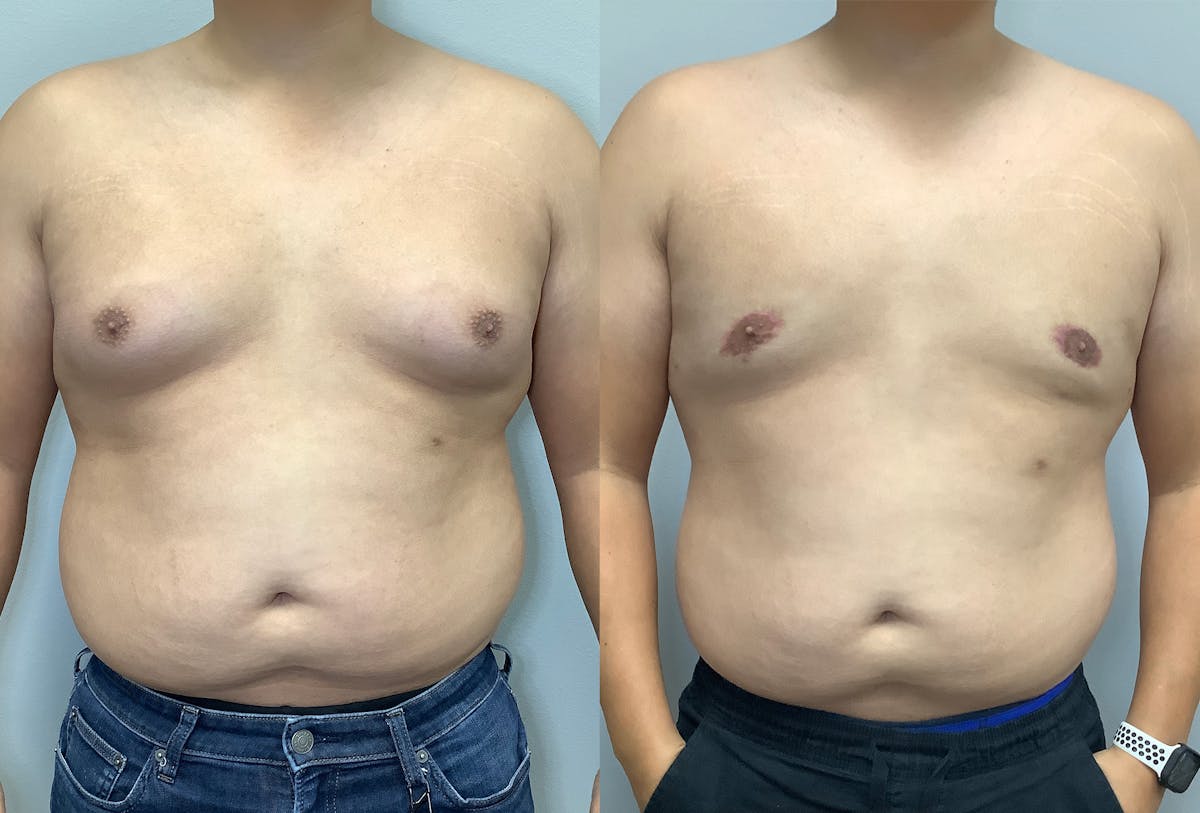 Gynecomastia Before & After Gallery - Patient 141595142 - Image 1
