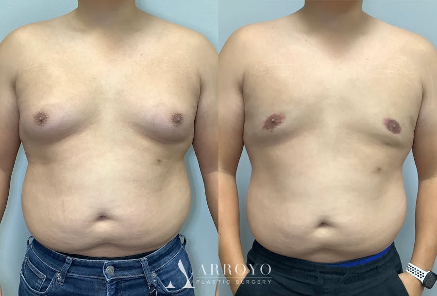 Gynecomastia Before & After Gallery - Patient 141595142 - Image 1