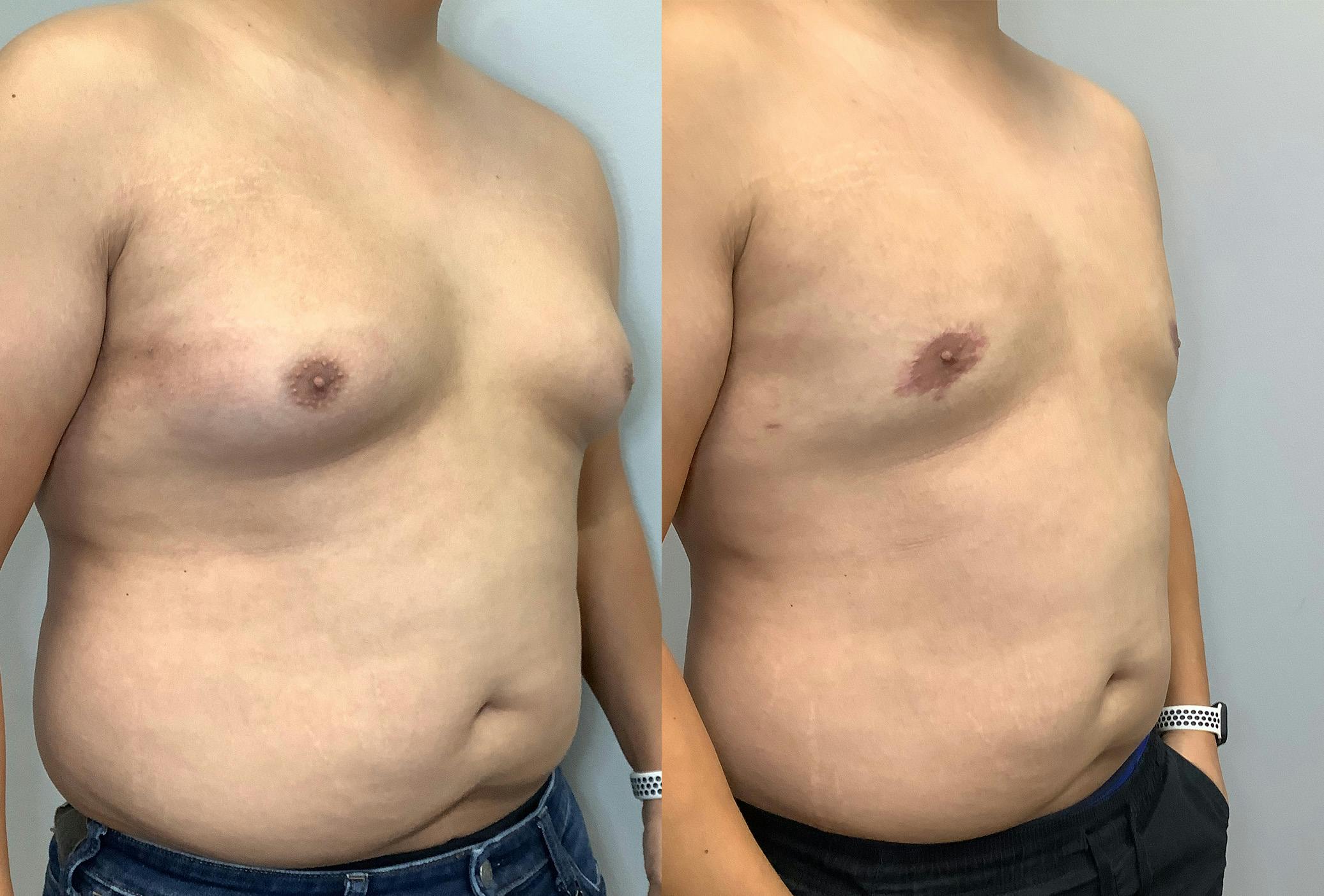 Gynecomastia Before & After Gallery - Patient 141595142 - Image 2