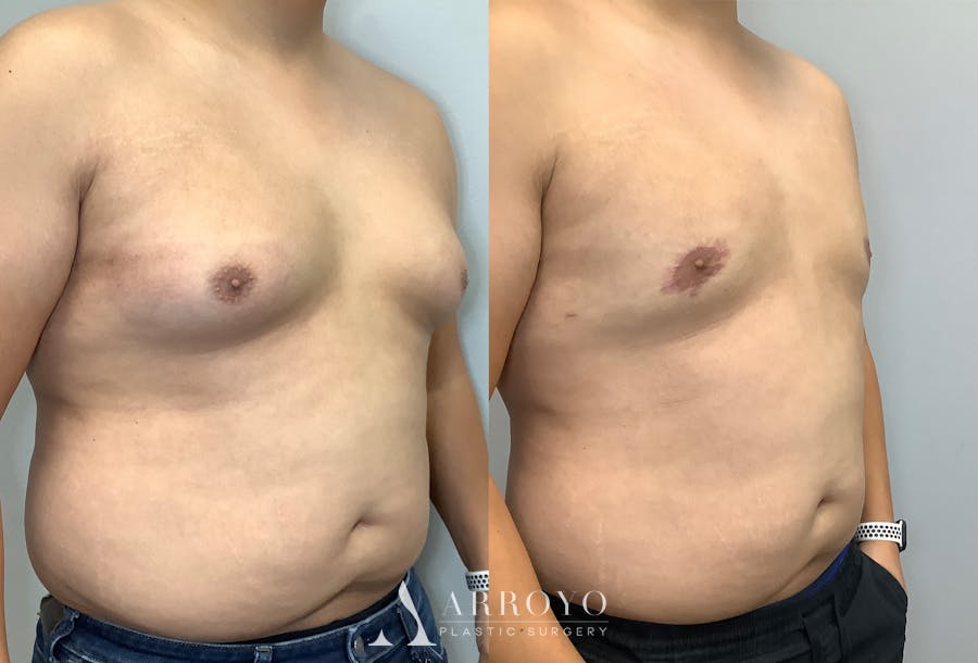 Gynecomastia Before & After Gallery - Patient 141595142 - Image 2