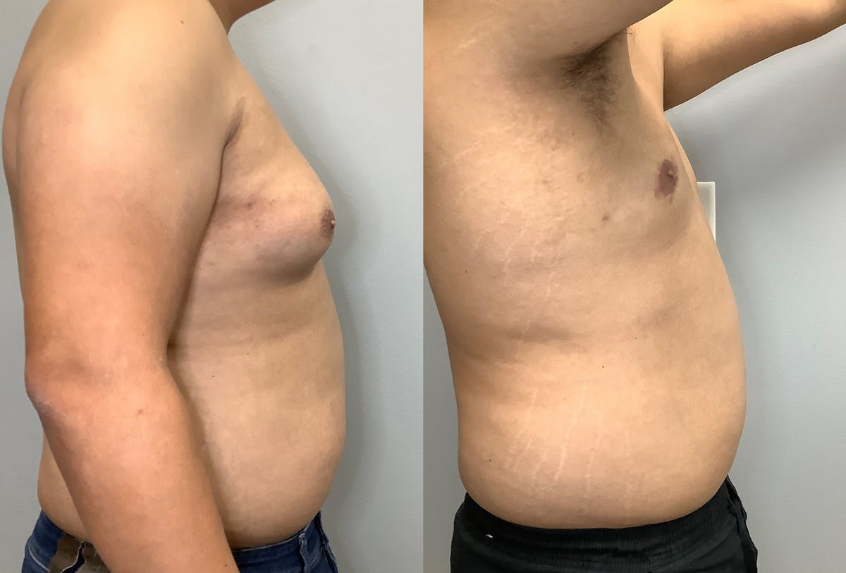 Gynecomastia Before & After Gallery - Patient 141595142 - Image 3