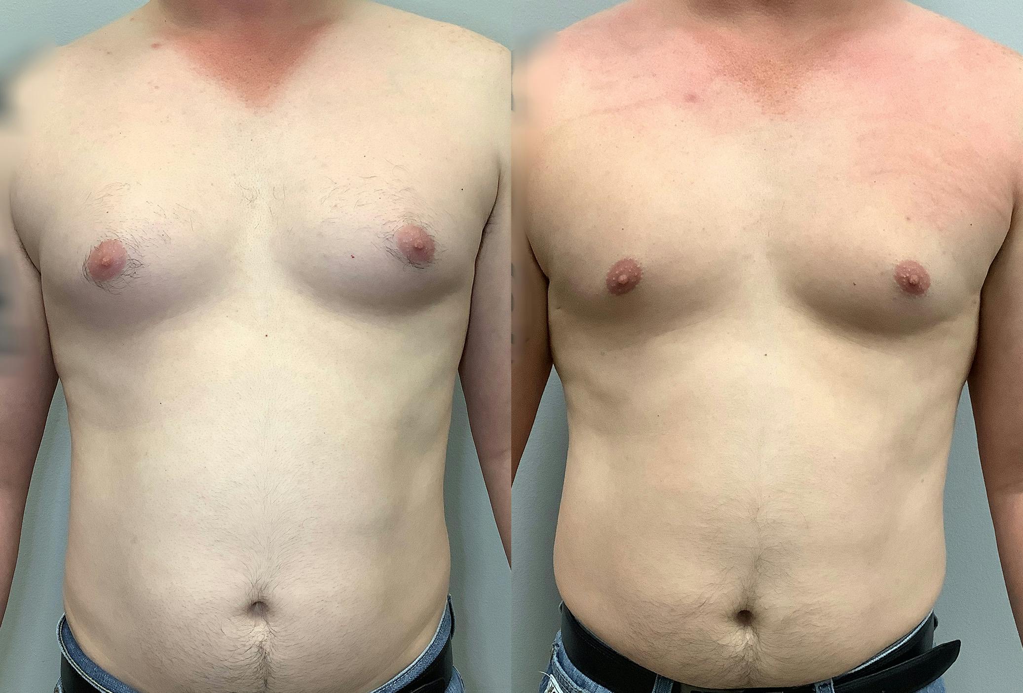 Gynecomastia Before & After Gallery - Patient 141595143 - Image 1