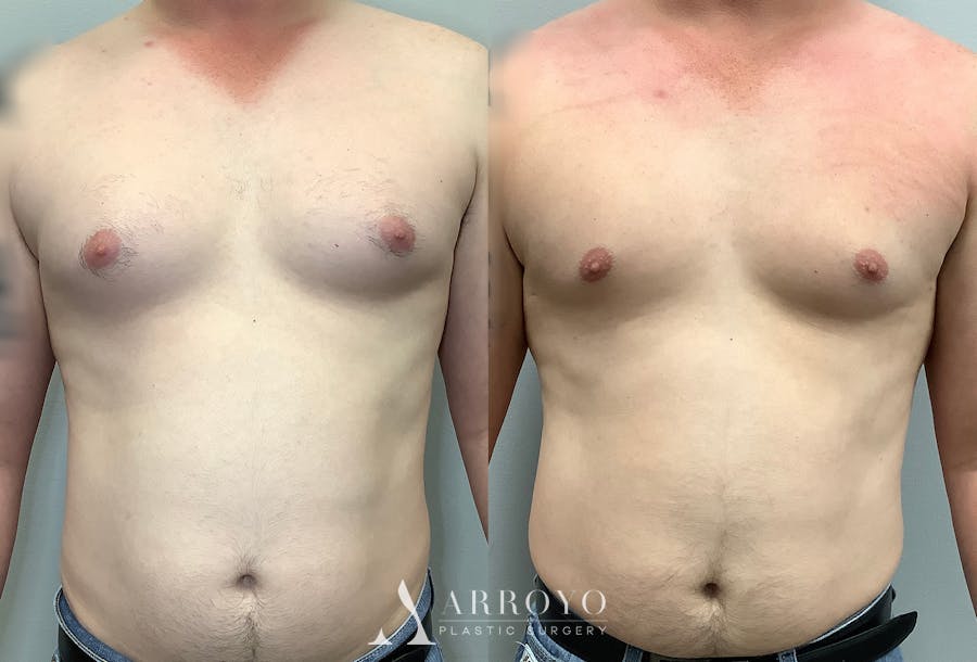 Gynecomastia Before & After Gallery - Patient 141595143 - Image 1