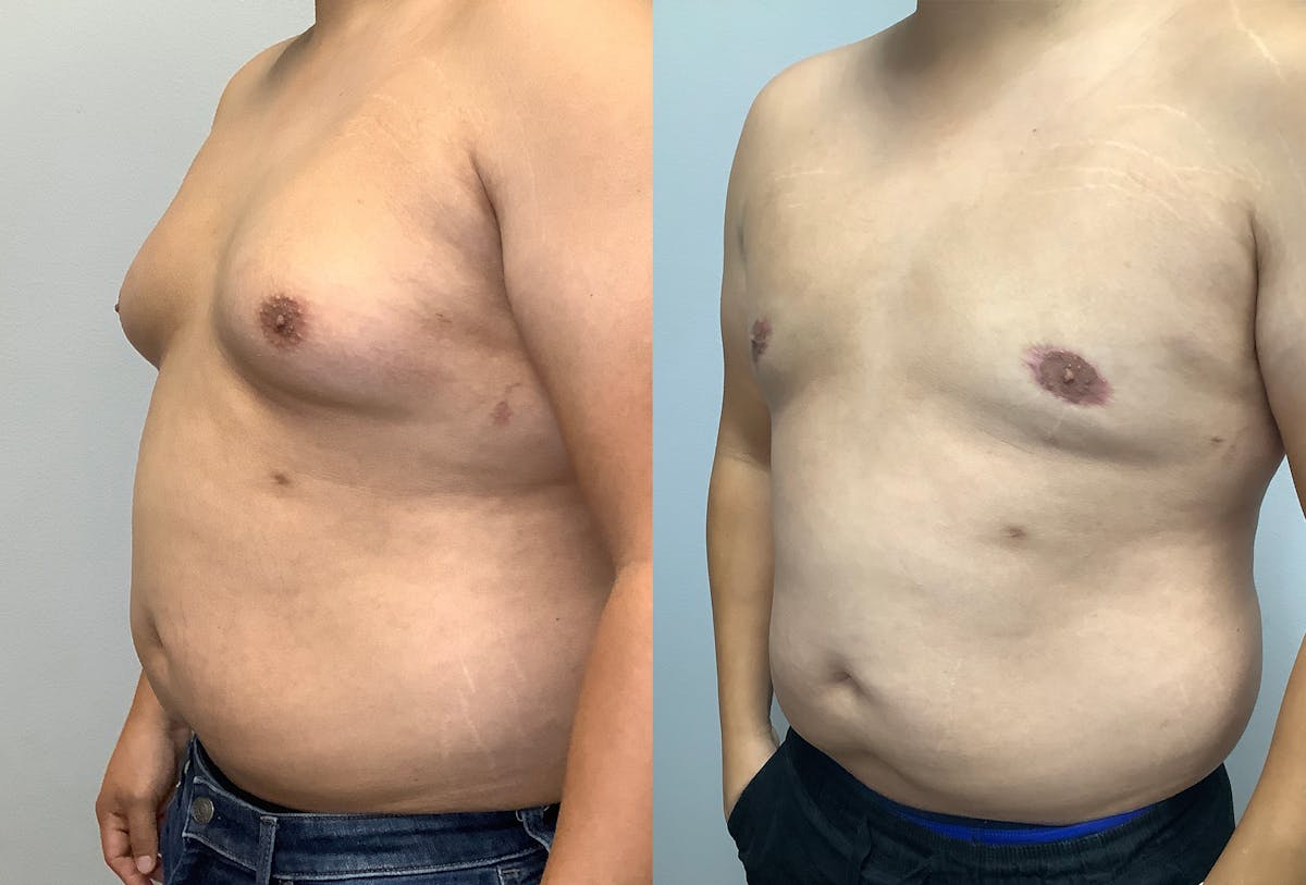 Gynecomastia Before & After Gallery - Patient 141595142 - Image 4