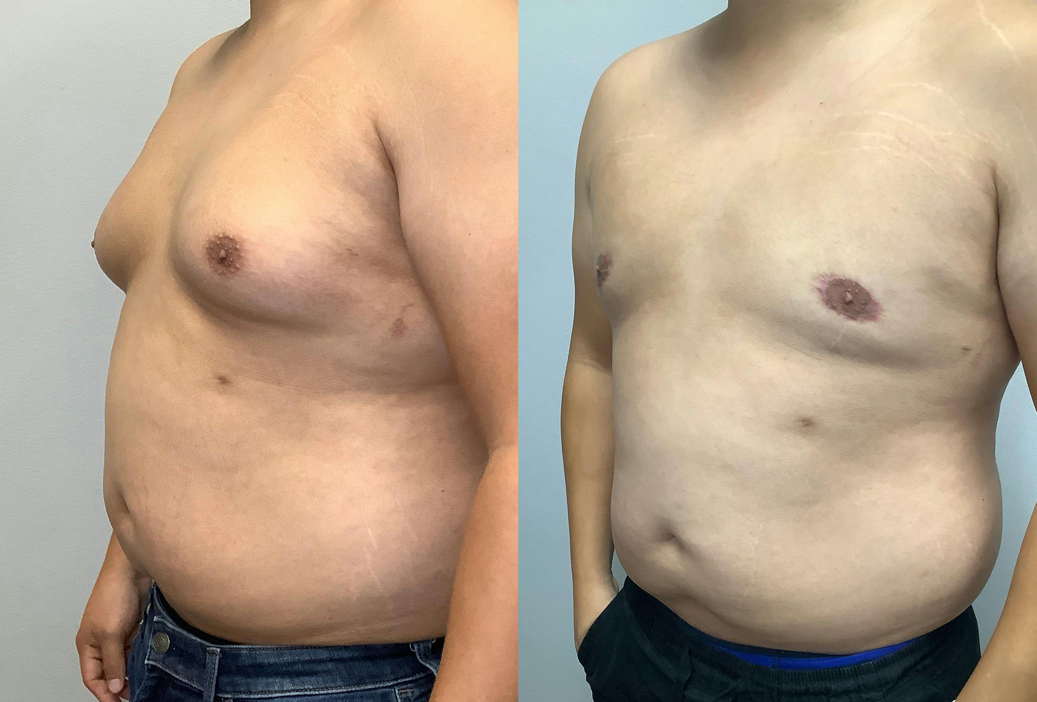 Gynecomastia Before & After Gallery - Patient 141595142 - Image 4