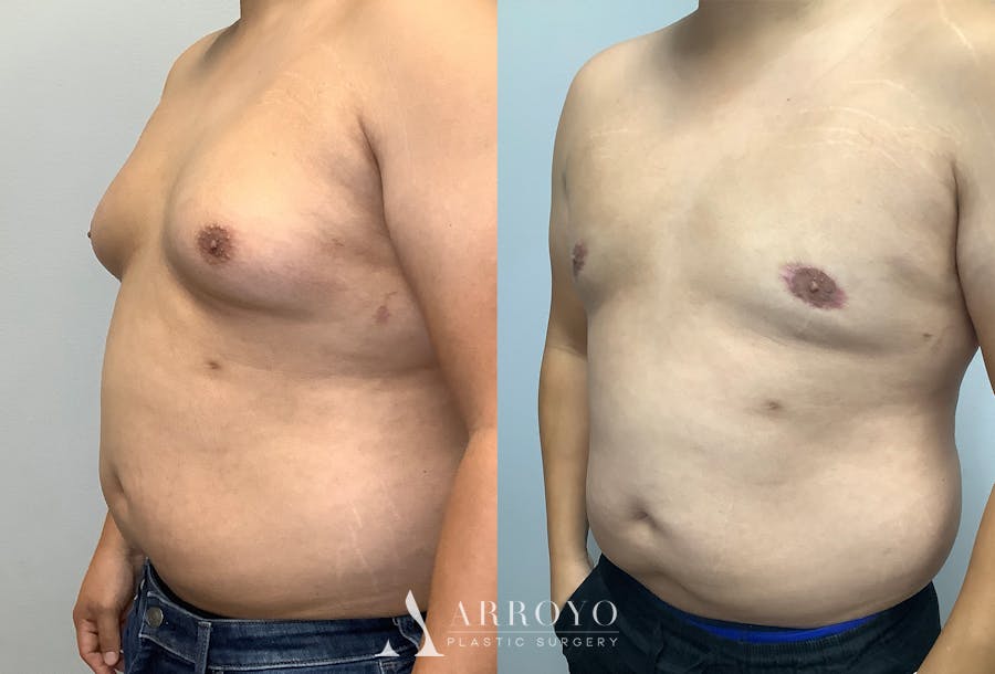 Gynecomastia Before & After Gallery - Patient 141595142 - Image 4