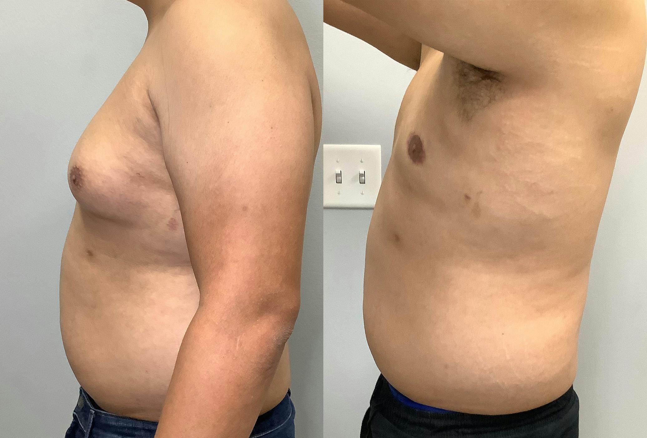 Gynecomastia Before & After Gallery - Patient 141595142 - Image 5