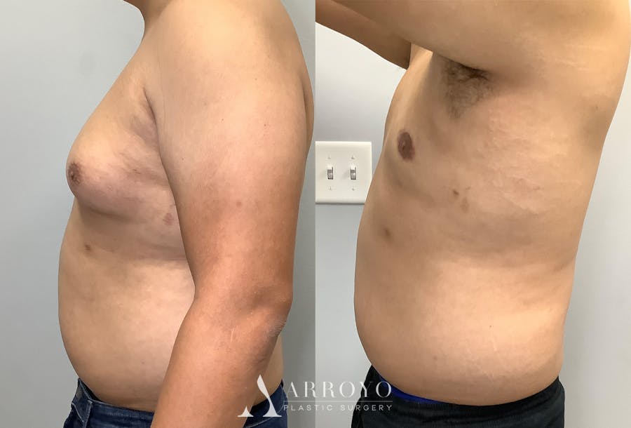 Gynecomastia Before & After Gallery - Patient 141595142 - Image 5