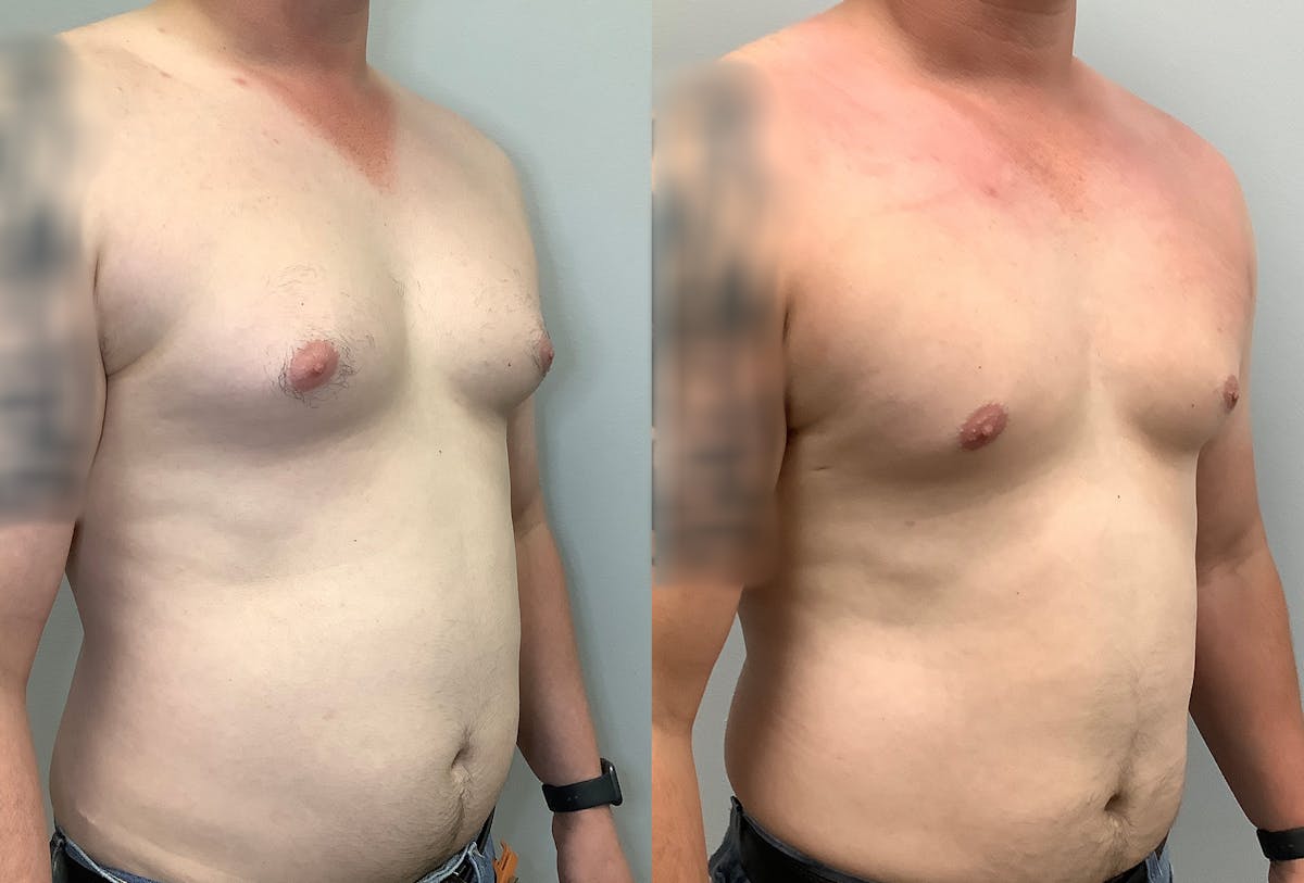 Gynecomastia Before & After Gallery - Patient 141595143 - Image 2