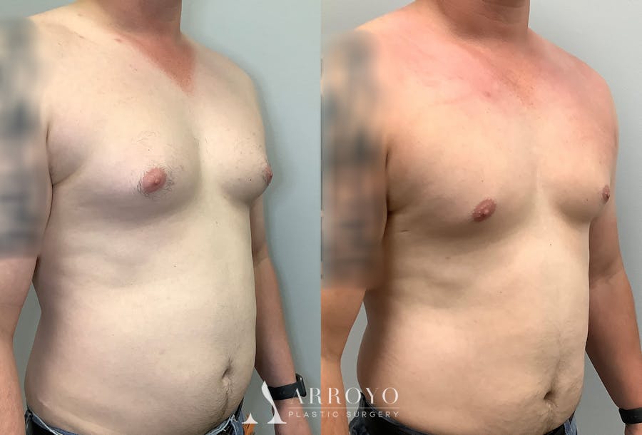 Gynecomastia Before & After Gallery - Patient 141595143 - Image 2