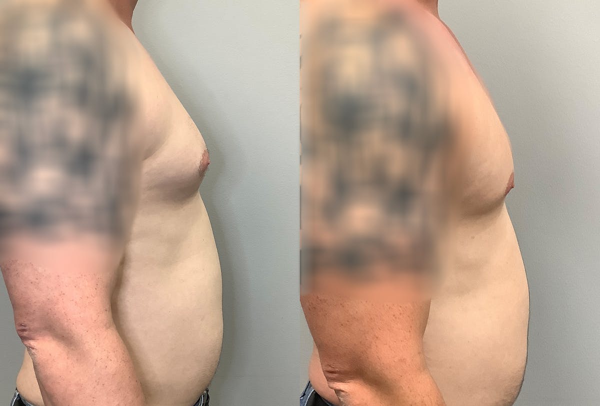 Gynecomastia Before & After Gallery - Patient 141595143 - Image 3