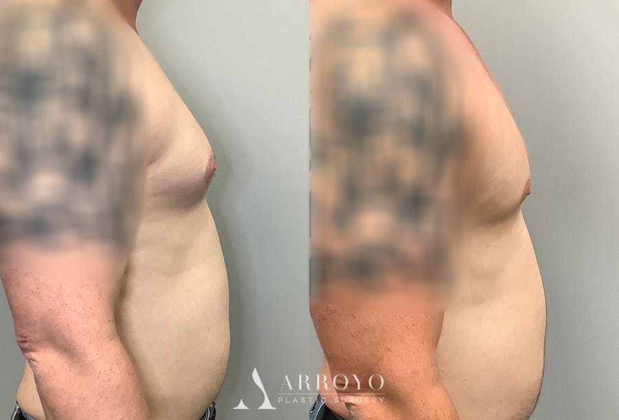 Gynecomastia Before & After Gallery - Patient 141595143 - Image 3