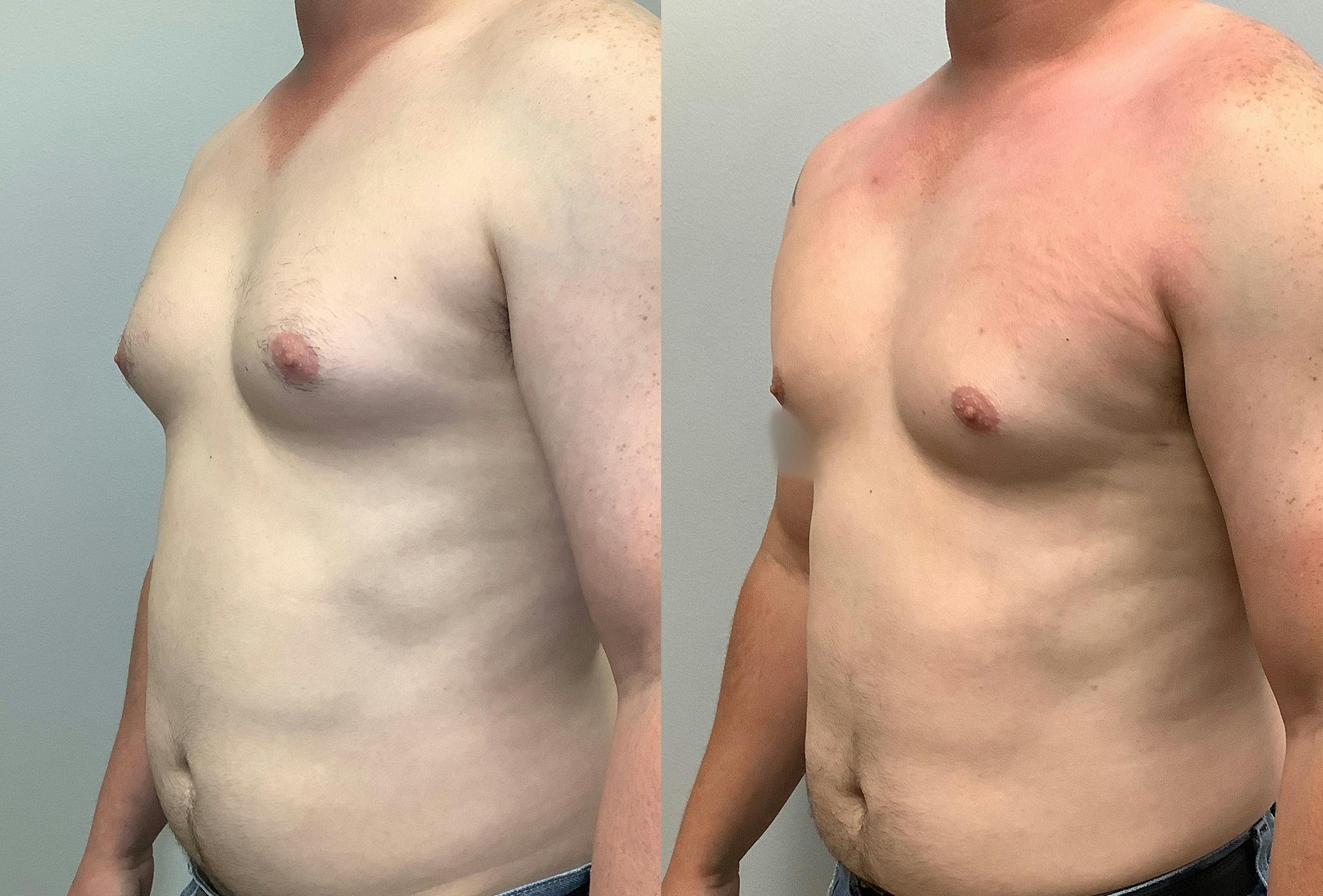 Gynecomastia Before & After Gallery - Patient 141595143 - Image 4