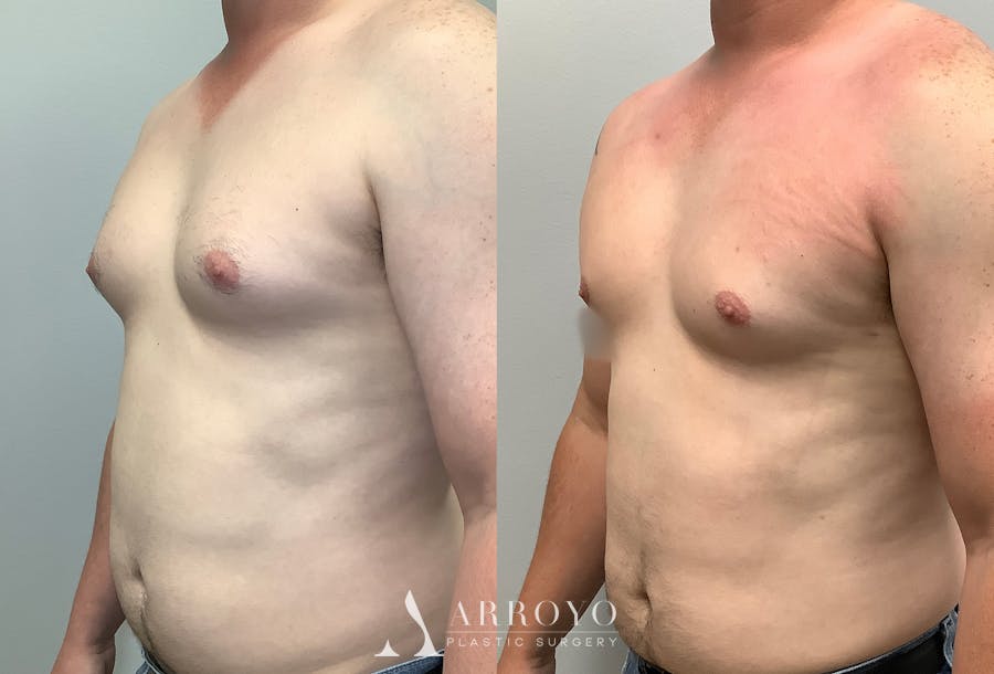 Gynecomastia Before & After Gallery - Patient 141595143 - Image 4