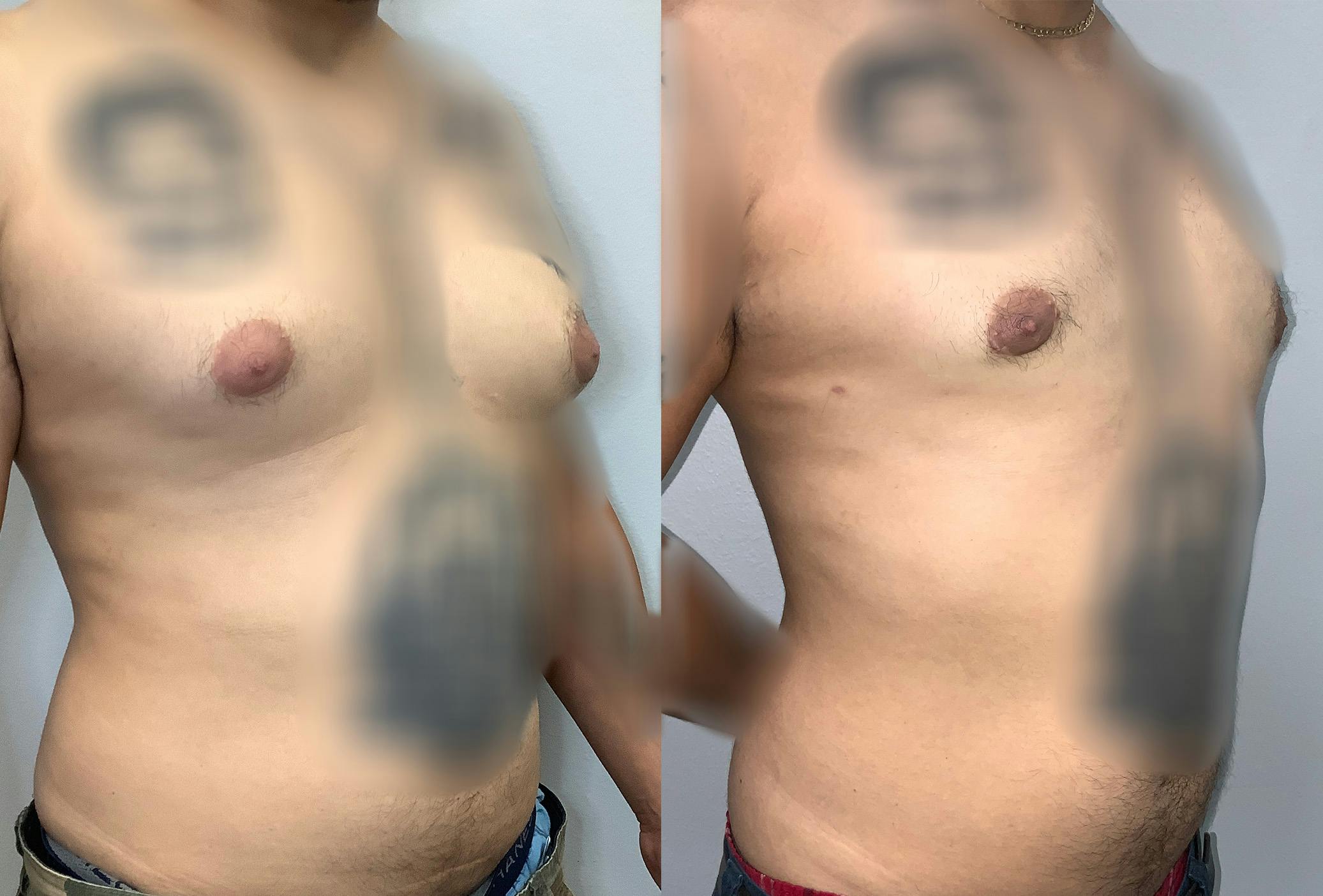 Gynecomastia Before & After Gallery - Patient 141595144 - Image 2