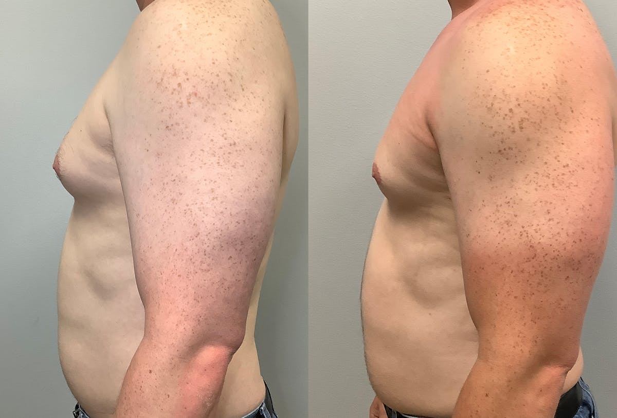 Gynecomastia Before & After Gallery - Patient 141595143 - Image 5