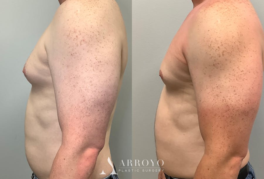 Gynecomastia Before & After Gallery - Patient 141595143 - Image 5
