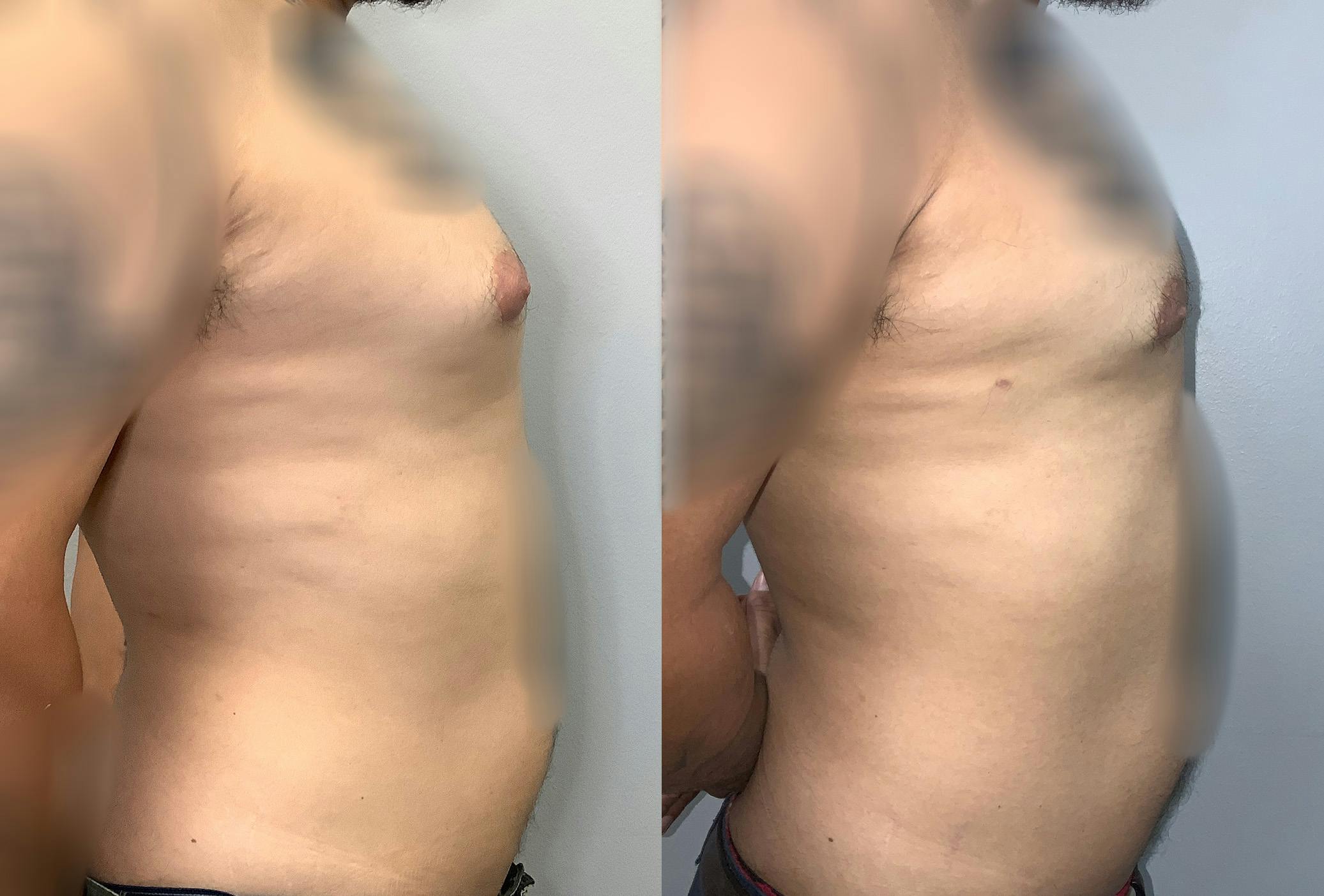 Gynecomastia Before & After Gallery - Patient 141595144 - Image 3
