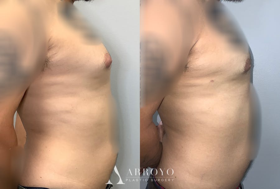 Gynecomastia Before & After Gallery - Patient 141595144 - Image 3