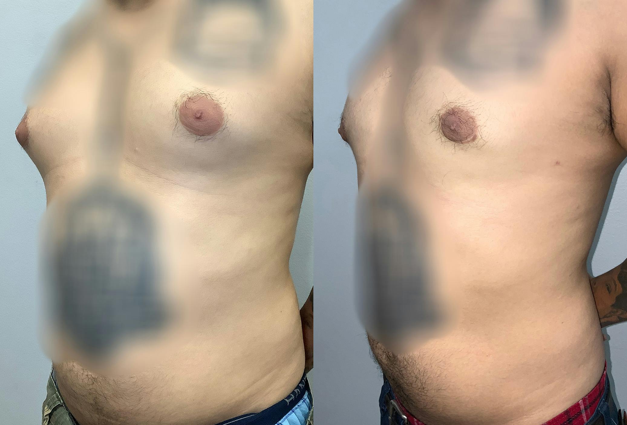 Gynecomastia Before & After Gallery - Patient 141595144 - Image 4