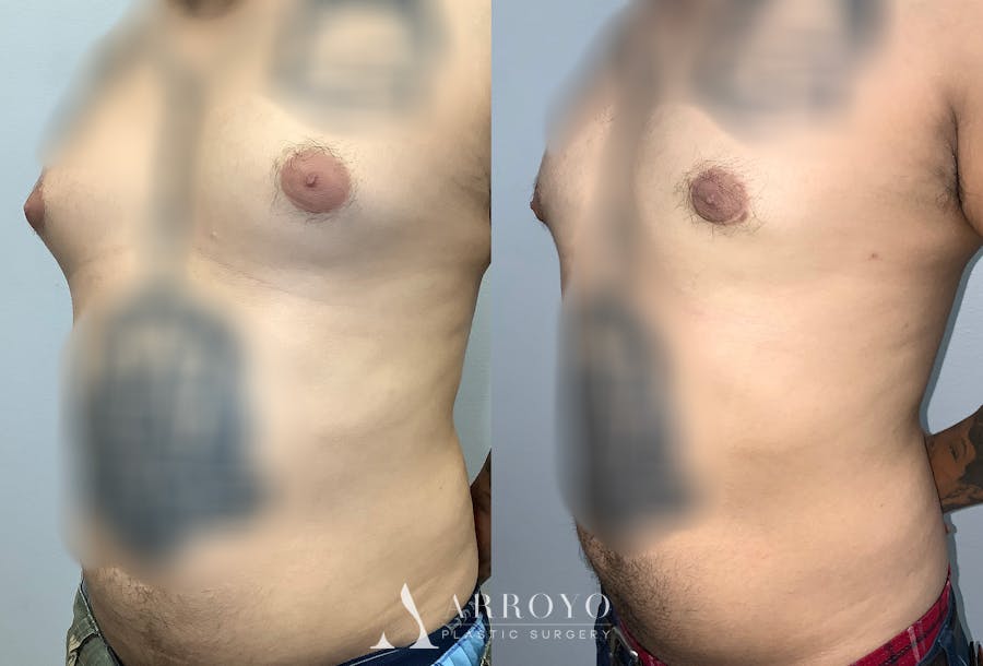 Gynecomastia Before & After Gallery - Patient 141595144 - Image 4