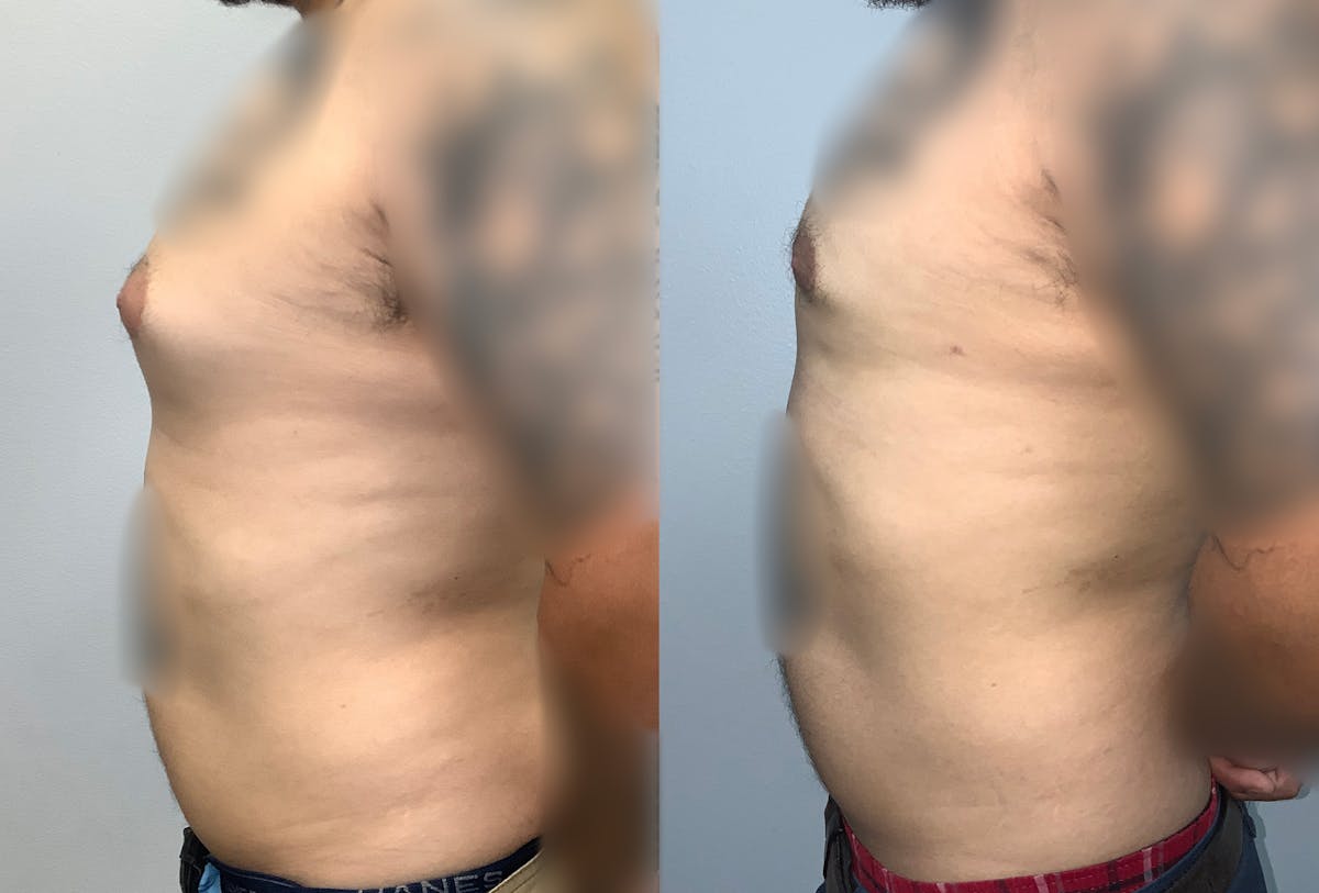 Gynecomastia Before & After Gallery - Patient 141595144 - Image 5