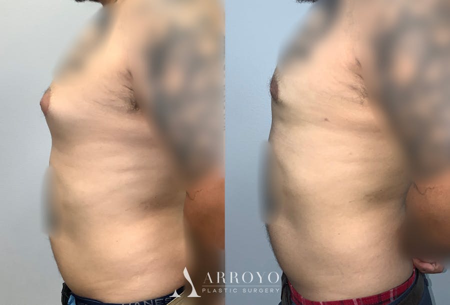 Gynecomastia Before & After Gallery - Patient 141595144 - Image 5