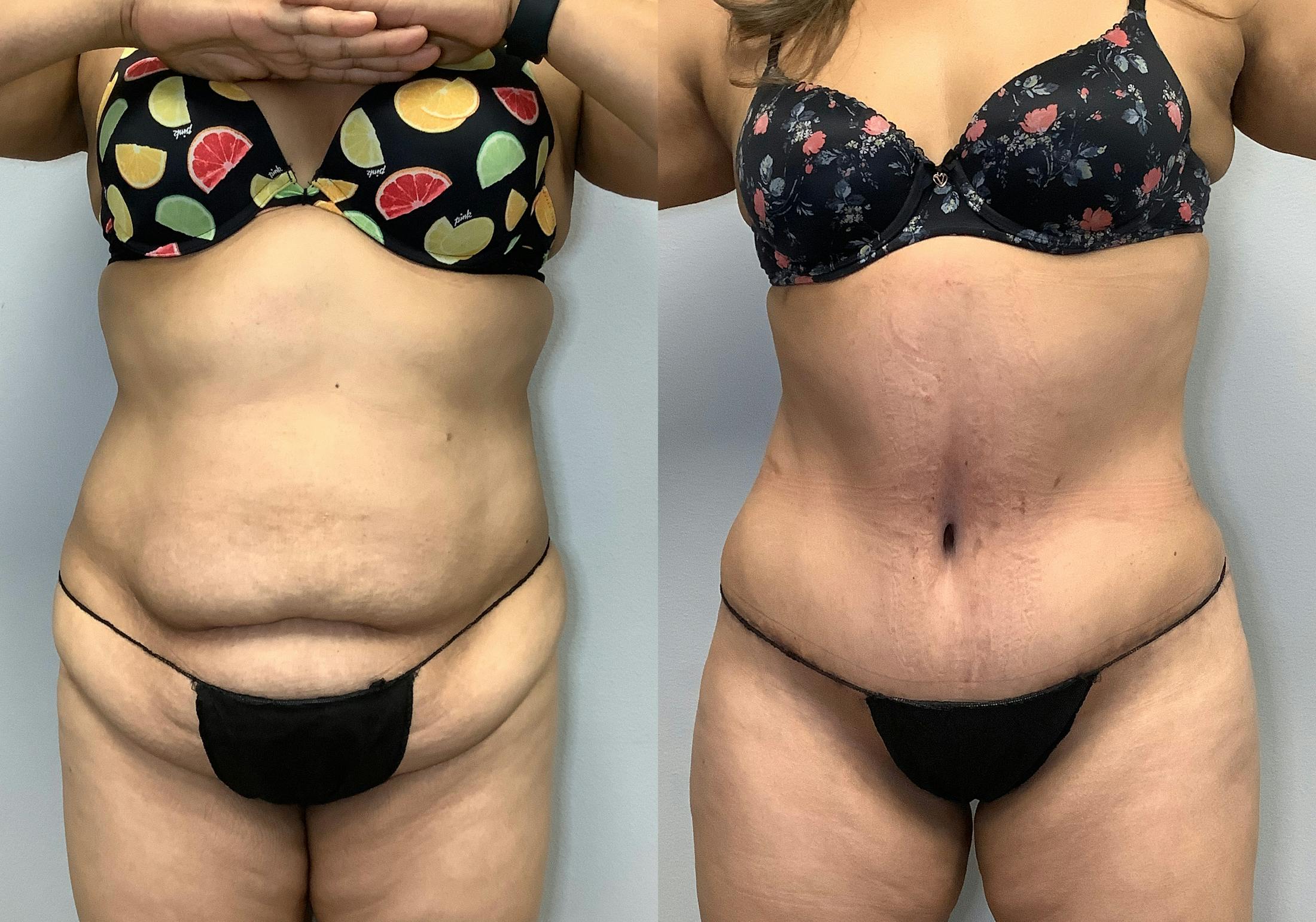 Tummy Tuck Before & After Gallery - Patient 141595184 - Image 1