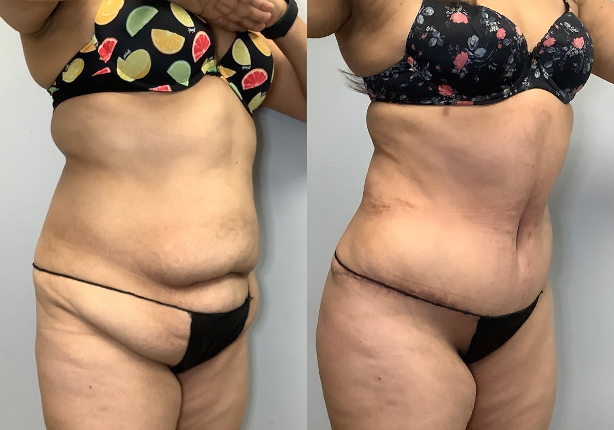 Brazilian Butt Lift Before & After Gallery - Patient 141595180 - Image 2