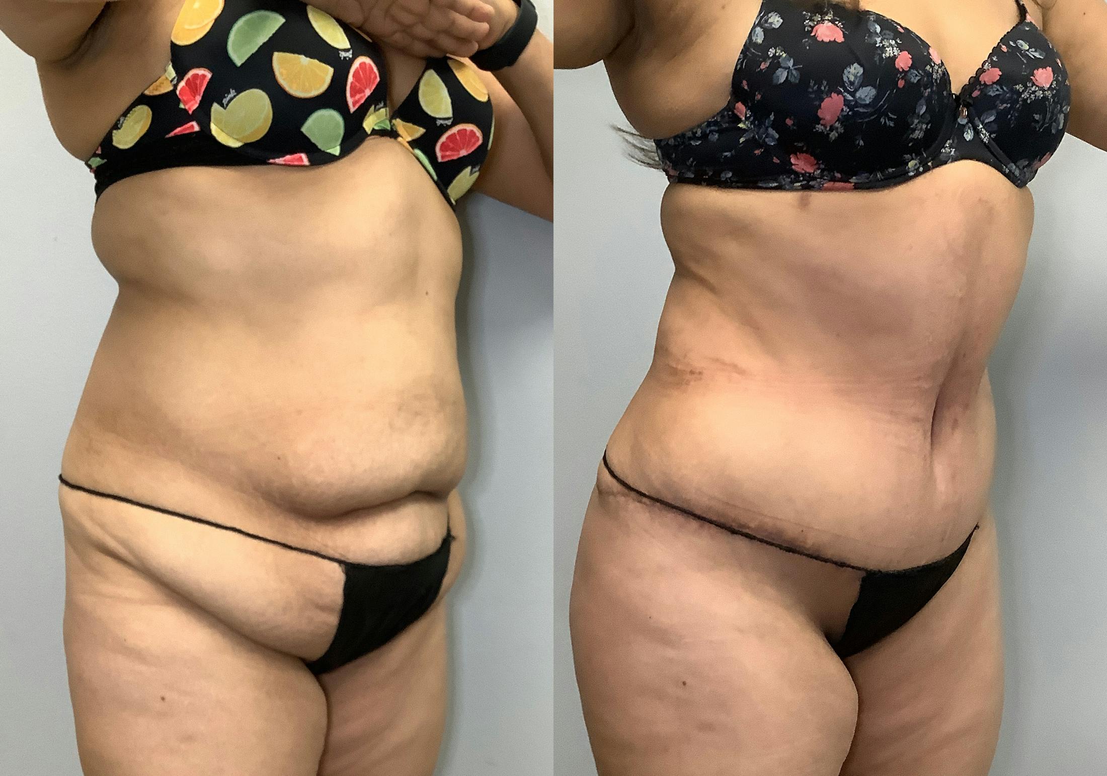 Tummy Tuck Before & After Gallery - Patient 141595184 - Image 2