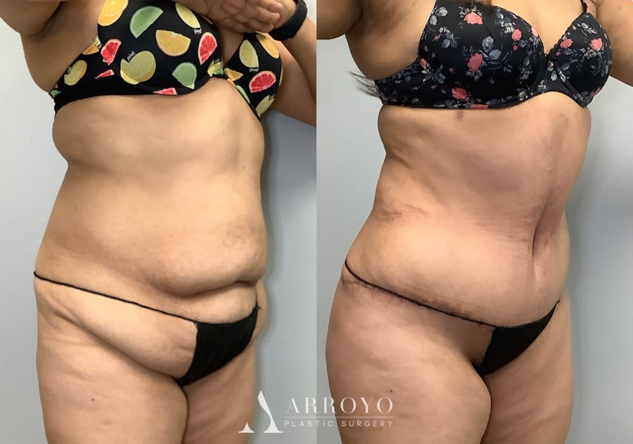 Brazilian Butt Lift Before & After Gallery - Patient 141595180 - Image 2