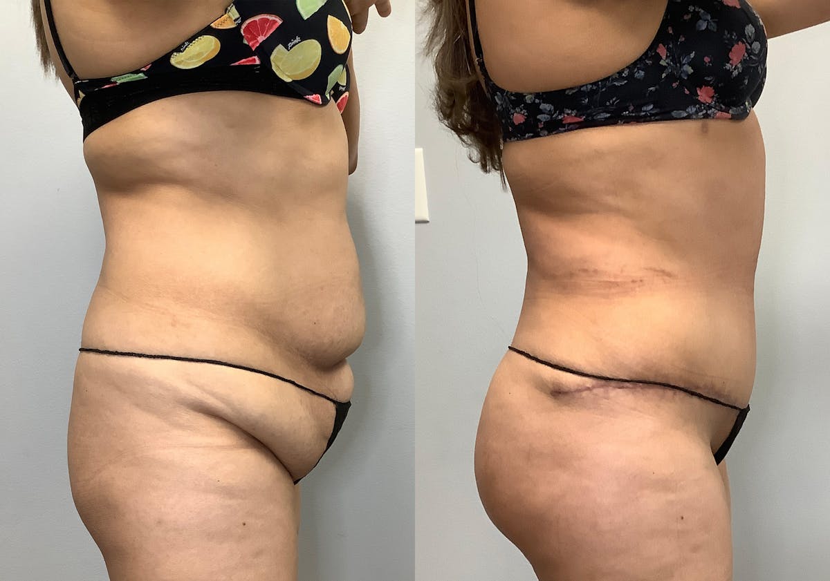 Brazilian Butt Lift Before & After Gallery - Patient 141595180 - Image 3