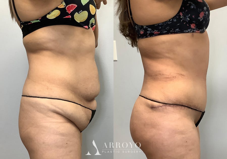 Brazilian Butt Lift Before & After Gallery - Patient 141595180 - Image 3