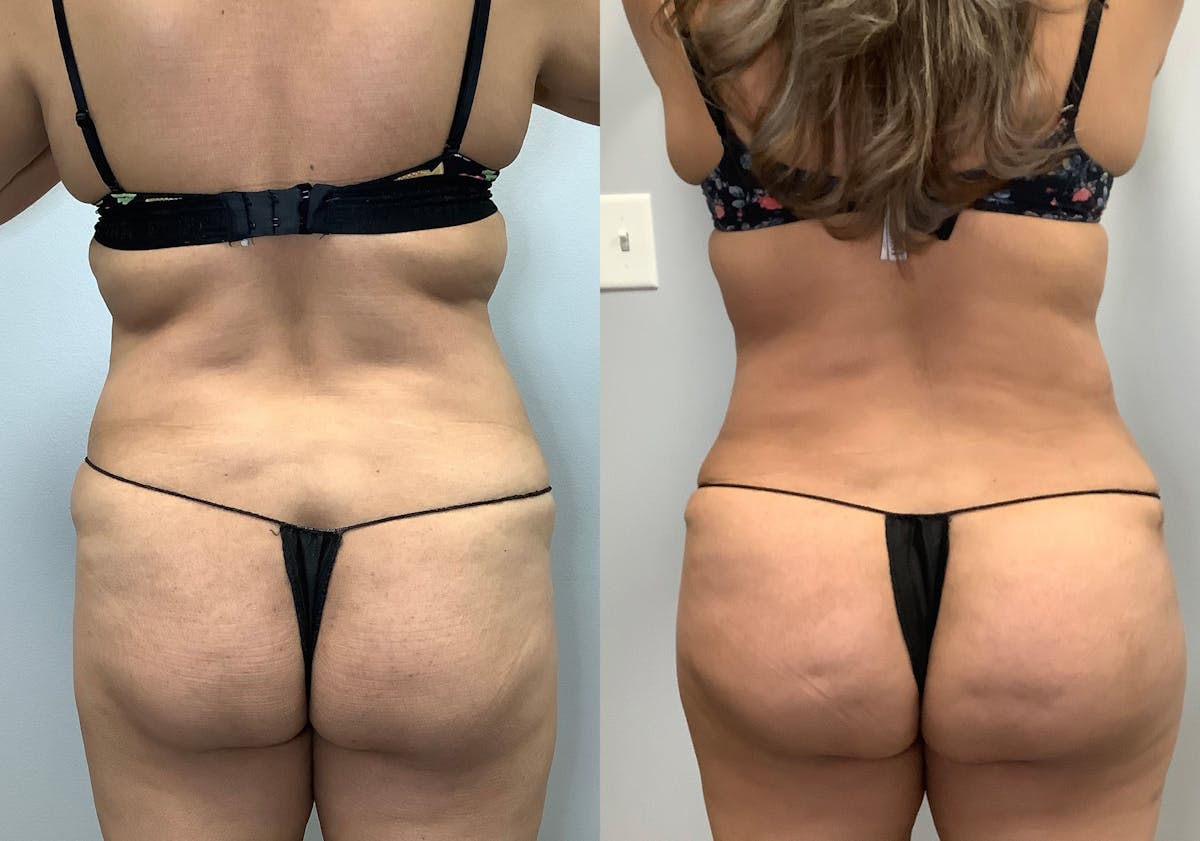 Tummy Tuck Before & After Gallery - Patient 141595184 - Image 4