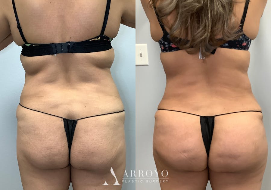 Brazilian Butt Lift Before & After Gallery - Patient 141595180 - Image 4