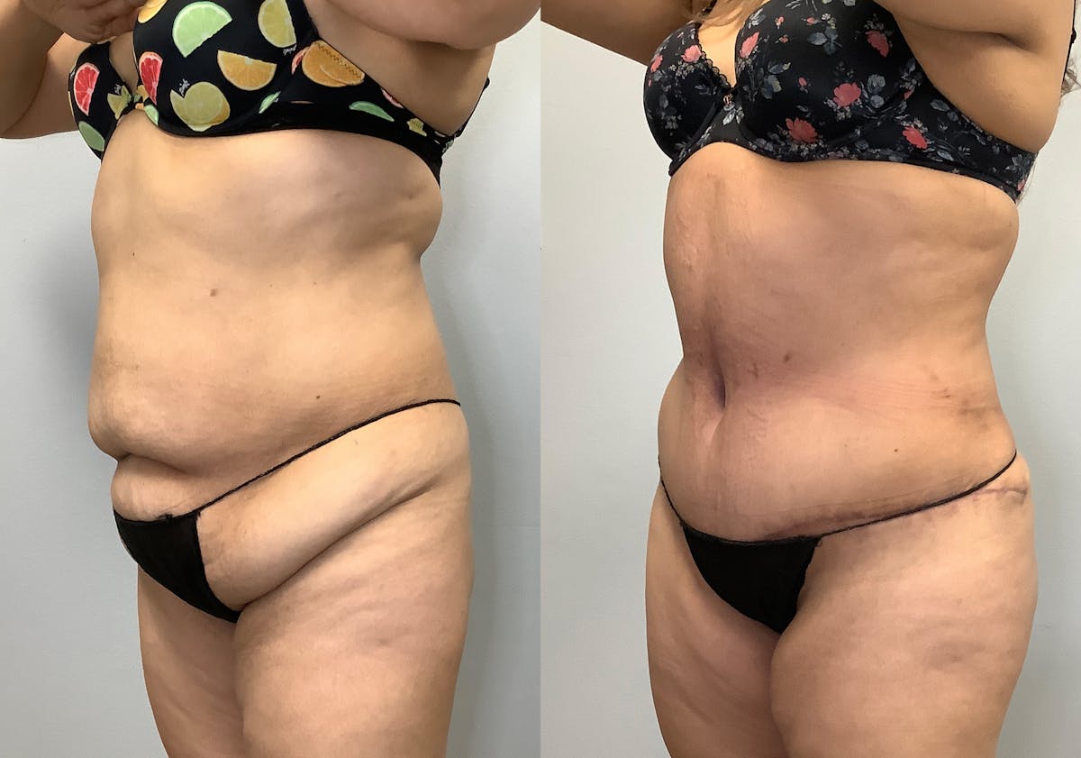Brazilian Butt Lift Before & After Gallery - Patient 141595180 - Image 5