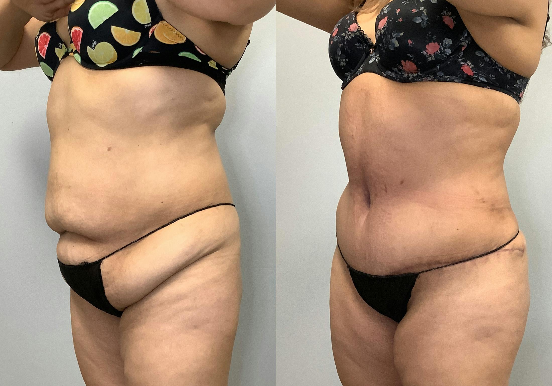 Brazilian Butt Lift Before & After Gallery - Patient 141595180 - Image 5