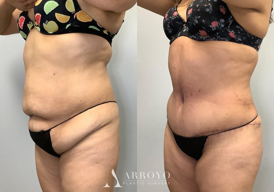 Brazilian Butt Lift Before & After Gallery - Patient 141595180 - Image 5