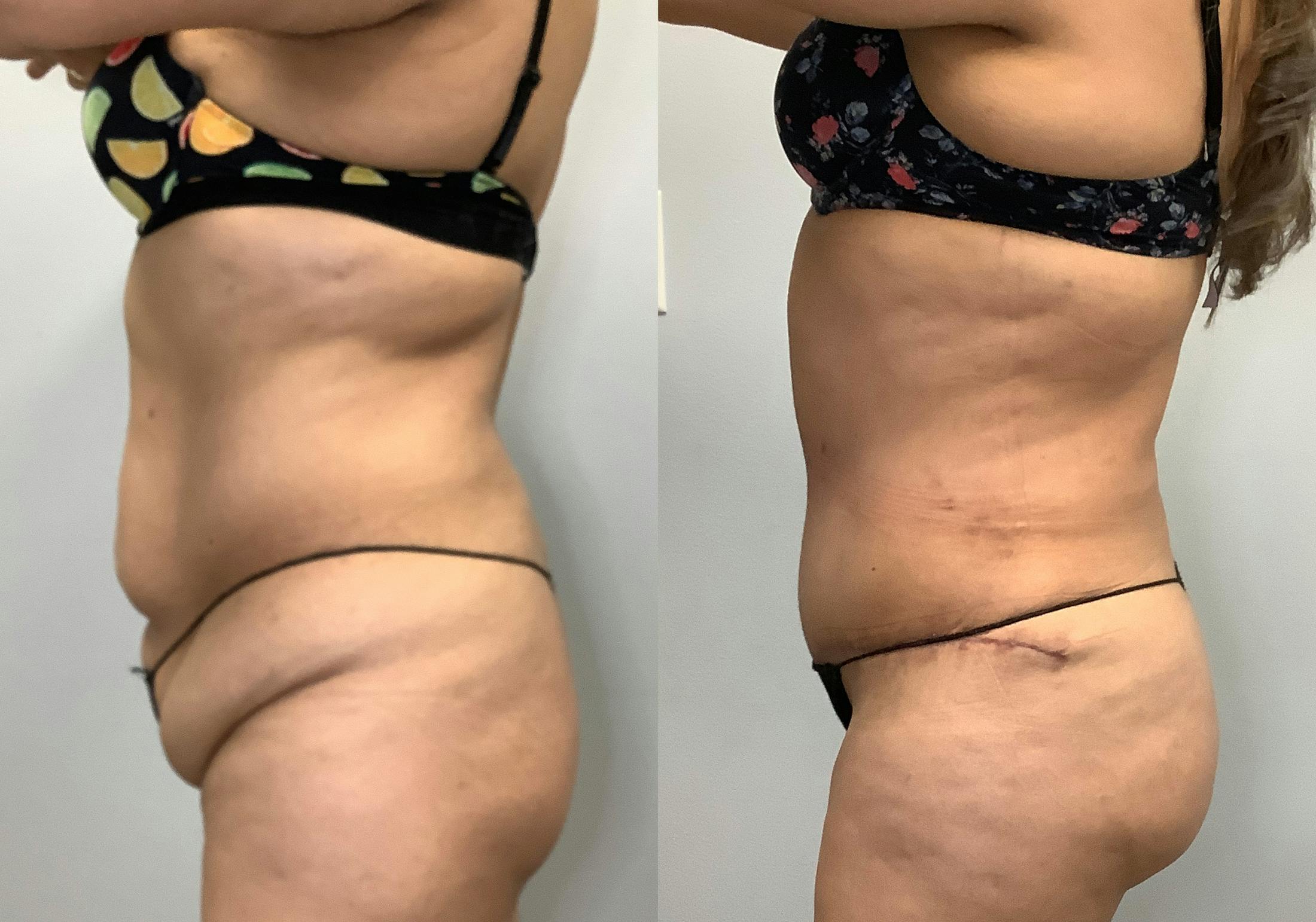 Tummy Tuck Before & After Gallery - Patient 141595184 - Image 6