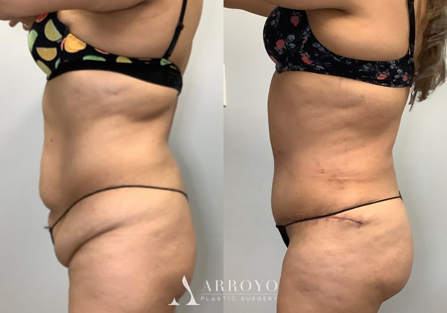 Brazilian Butt Lift Before & After Gallery - Patient 141595180 - Image 6