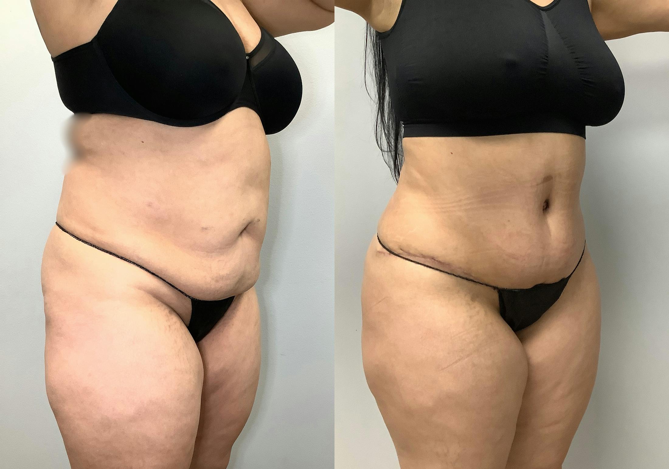 Tummy Tuck Before & After Gallery - Patient 141595112 - Image 3