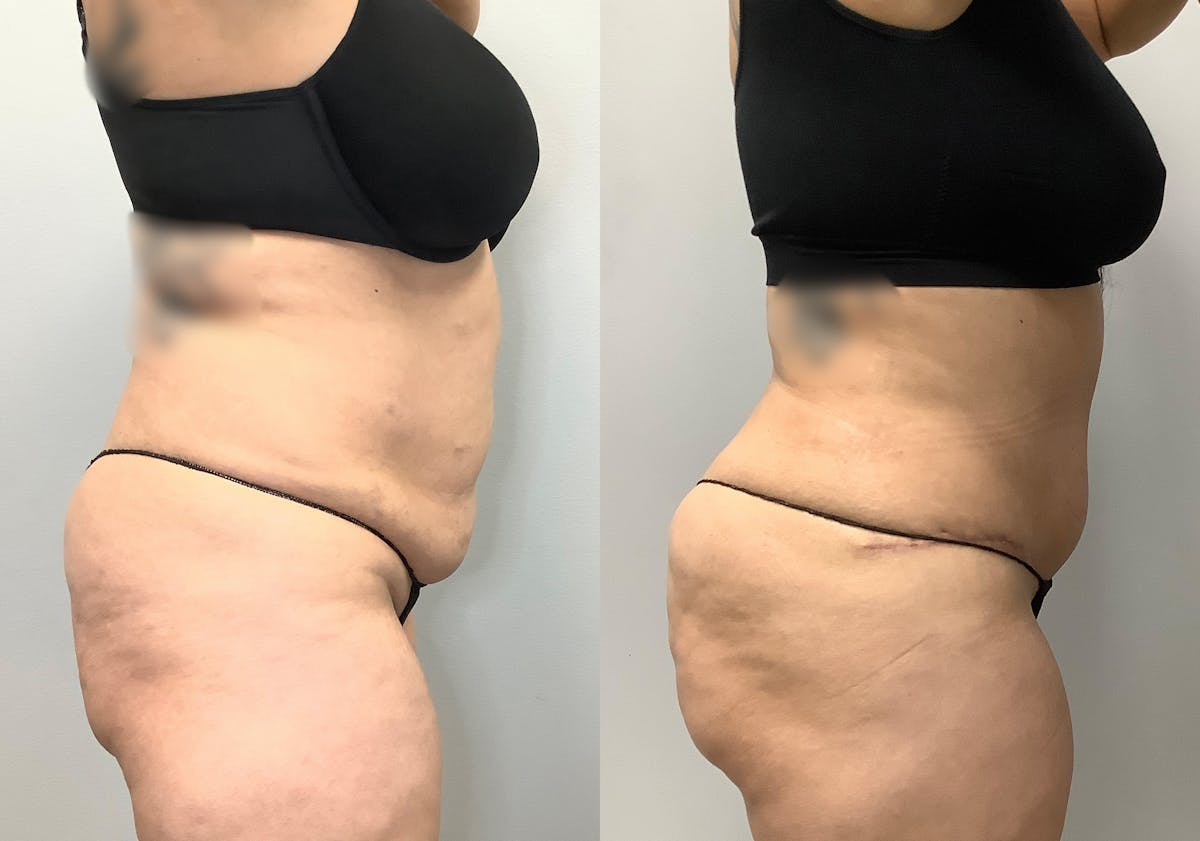 Tummy Tuck Before & After Gallery - Patient 141595112 - Image 4
